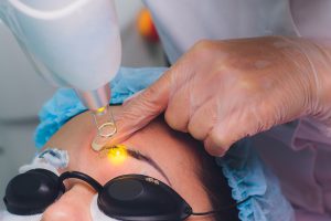 Ștergere tatuaje cu laser – BH Body Studio Militari